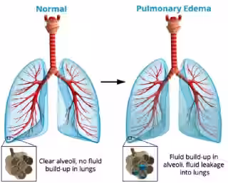 High Altitude Pulmonary Edema.png High Altitude Pulmonary Edema.png